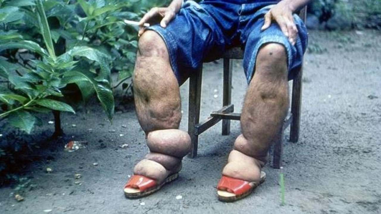 Penyakit Kaki Gajah